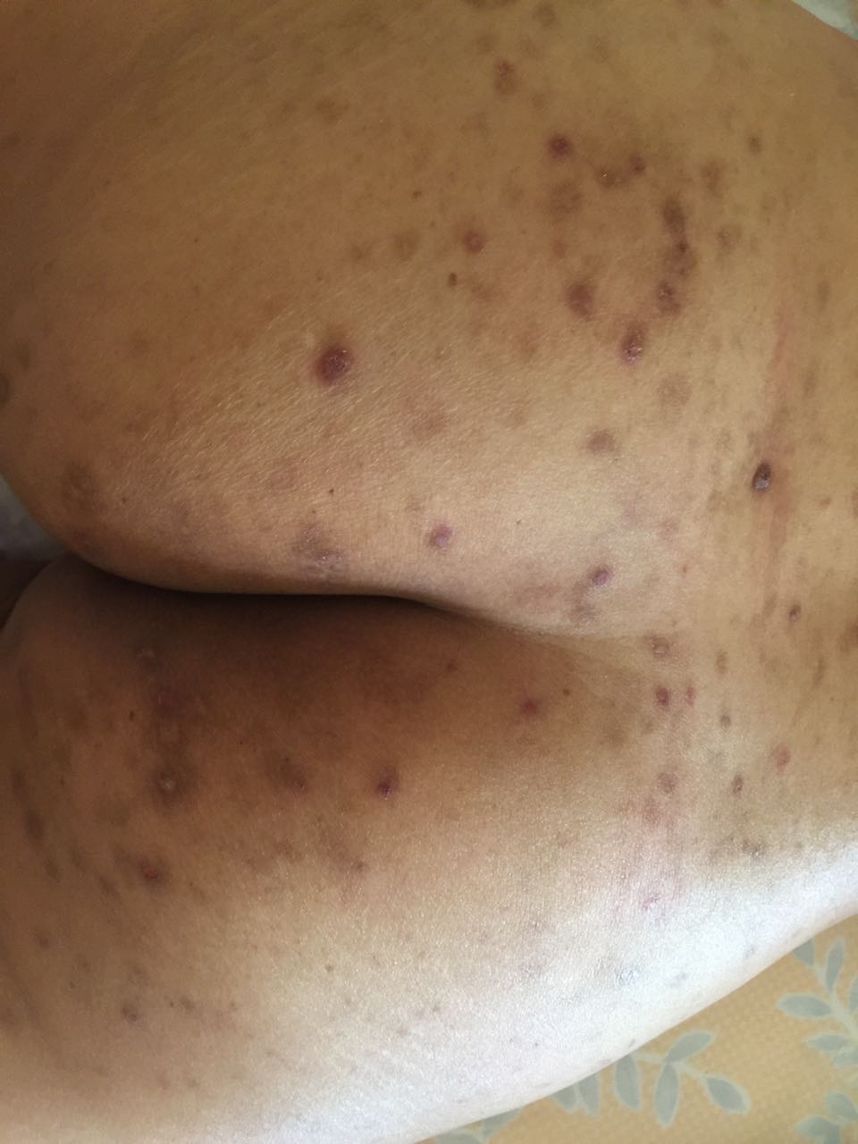 Diagnose The Skin Lesion