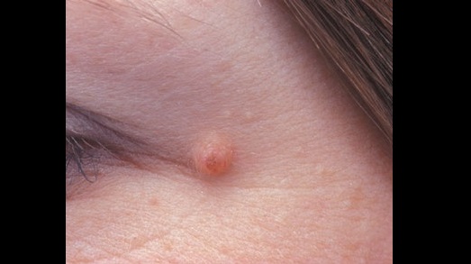 Dermatology Spot Diagnosis