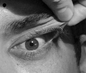 Ocular Manifestations Of Ehlers-Danlos Syndrome A Brief Review