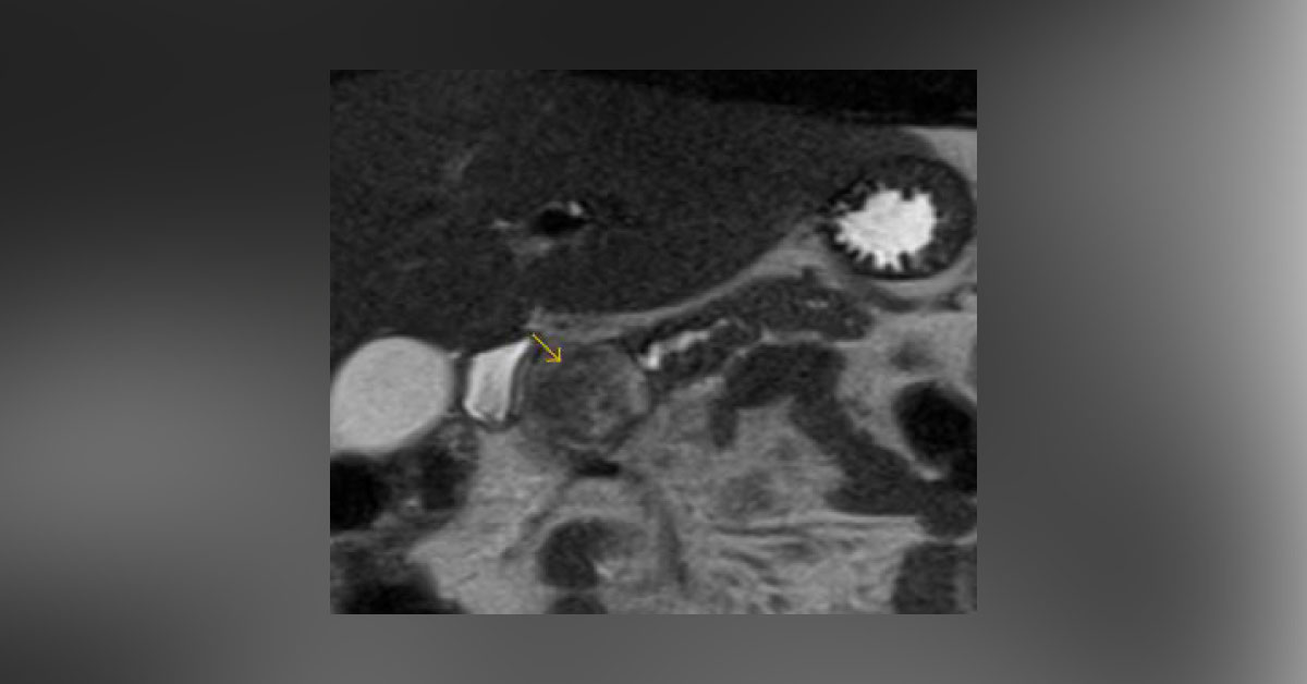 Acute Abdominal Pain In Young Girl