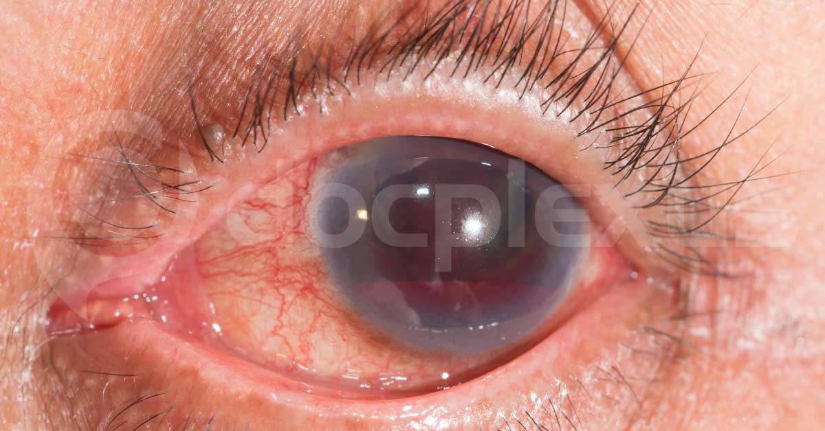 Novel Oral Antithrombotics And Intraocular Bleeding Risk