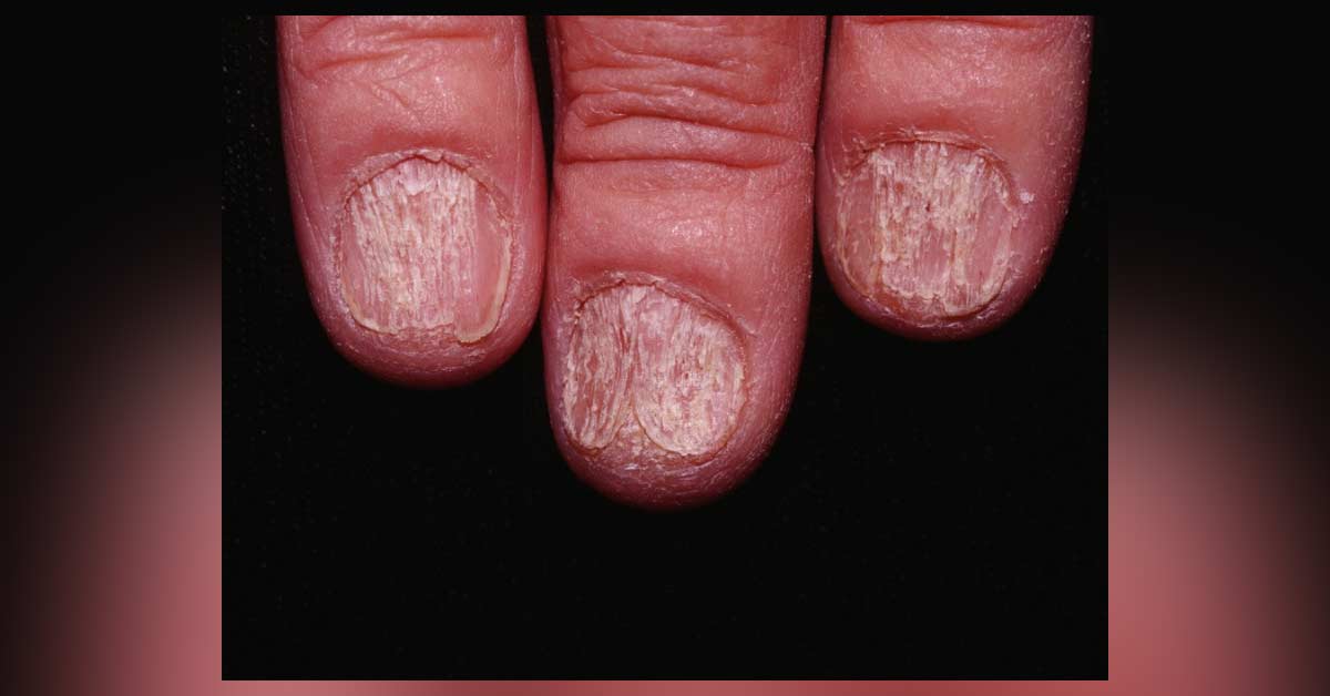 Identify The Nail Condition