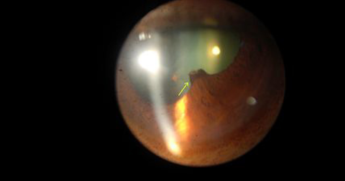 Spot The Ophthalmic Condition