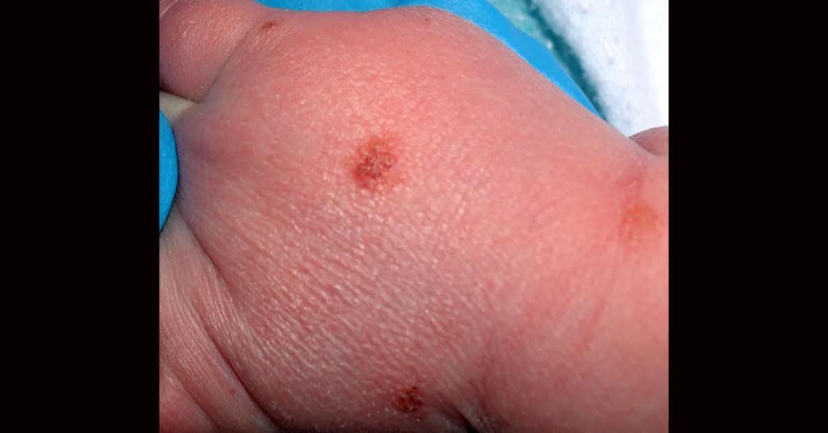 Diagnosis For A New Born Infant