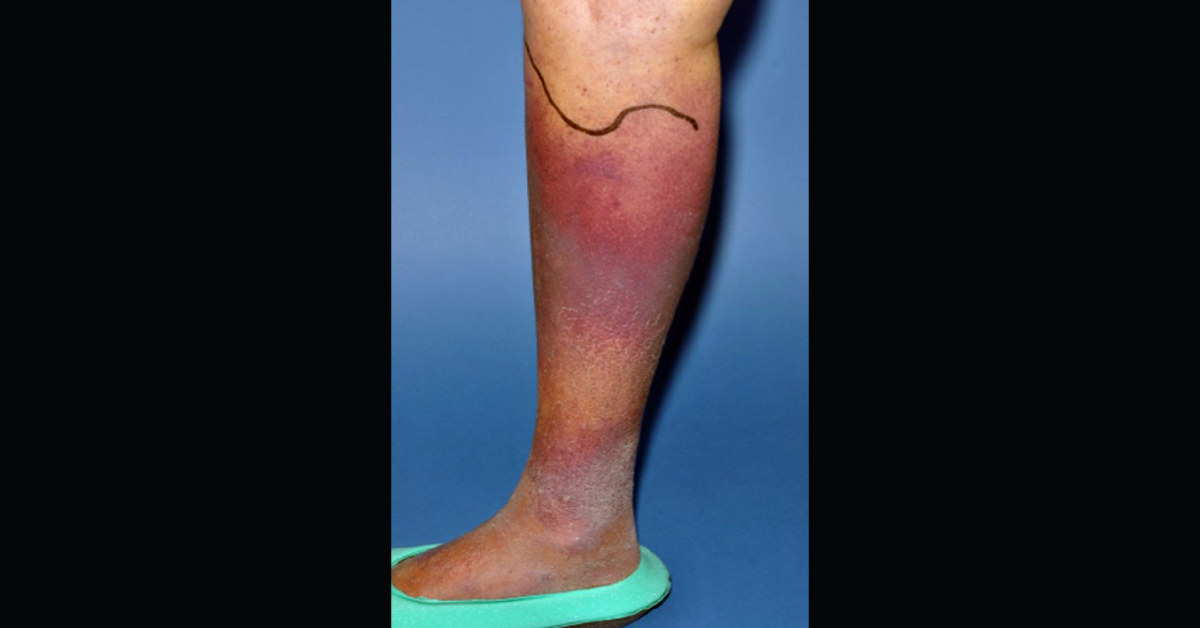 Discoloration Of Lower Limbs Of An Elderly