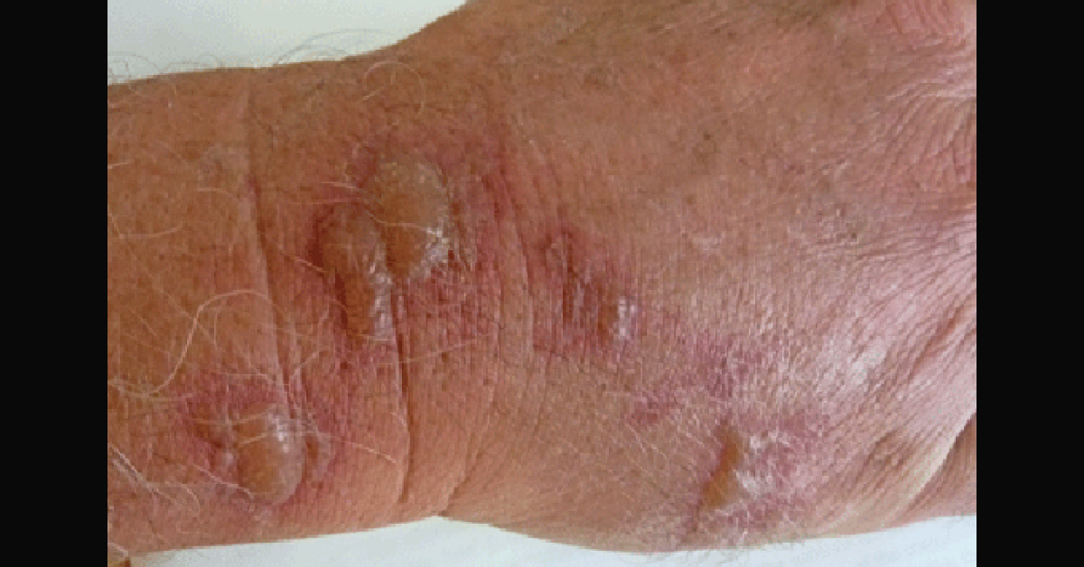 Identify The Blisters
