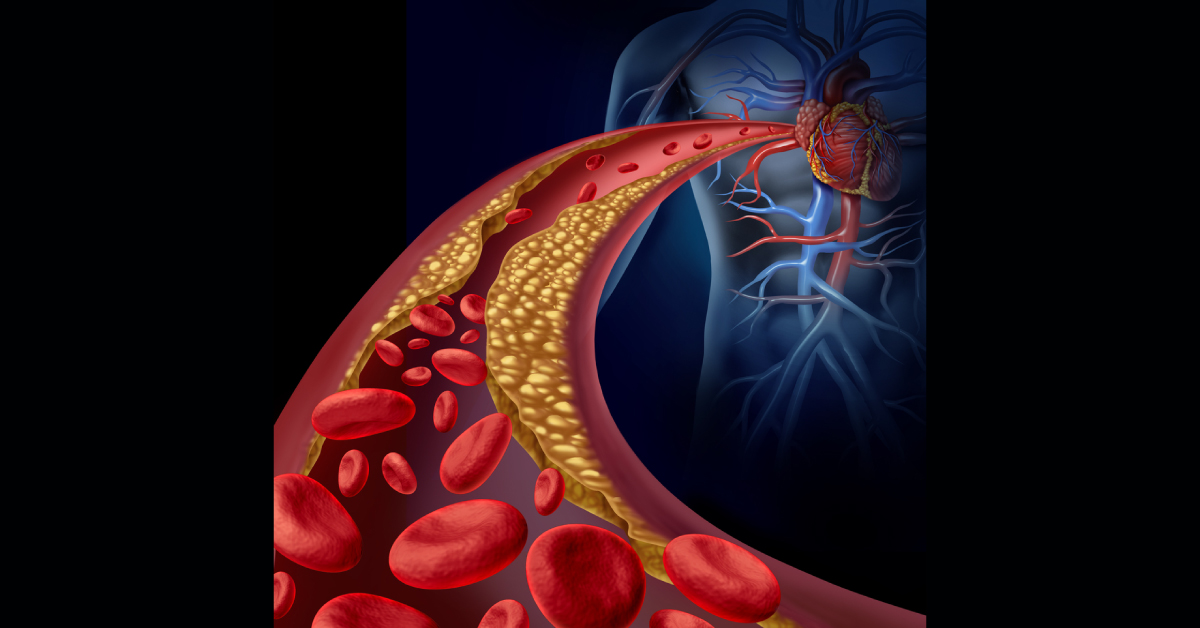 Atrial Fibrillation Surgery, What To Expect