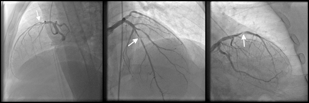 Coronary Artery Kinking, A Frequent Finding In Typical ACS Or AMI With Normal CAG