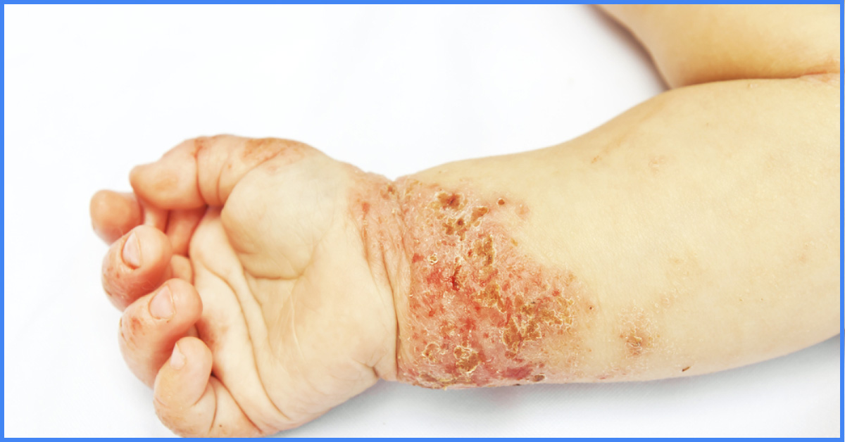 Antibiotics May Not Be Effective In Treating Eczema
