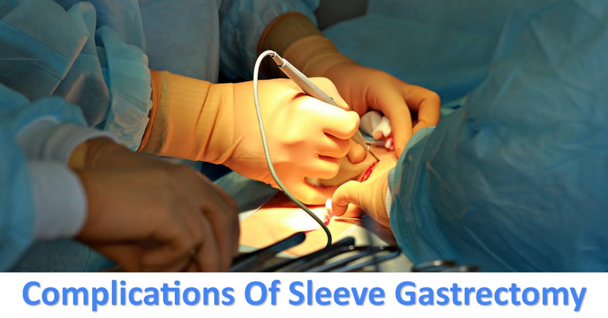 Sleeve Gastrectomy And Its Complications