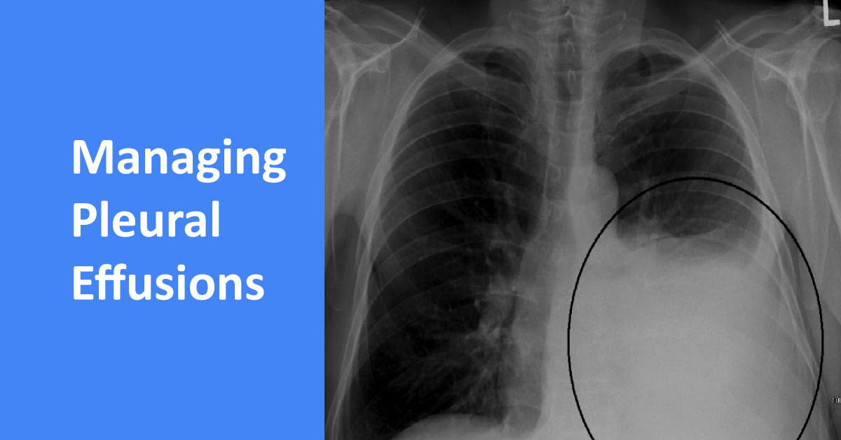 Management Of Malignant Pleural Effusions