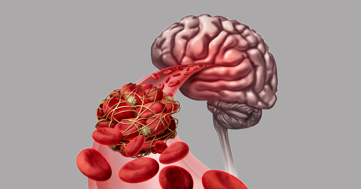 Use Of Warfarin In Cerebral Artery Thrombosis