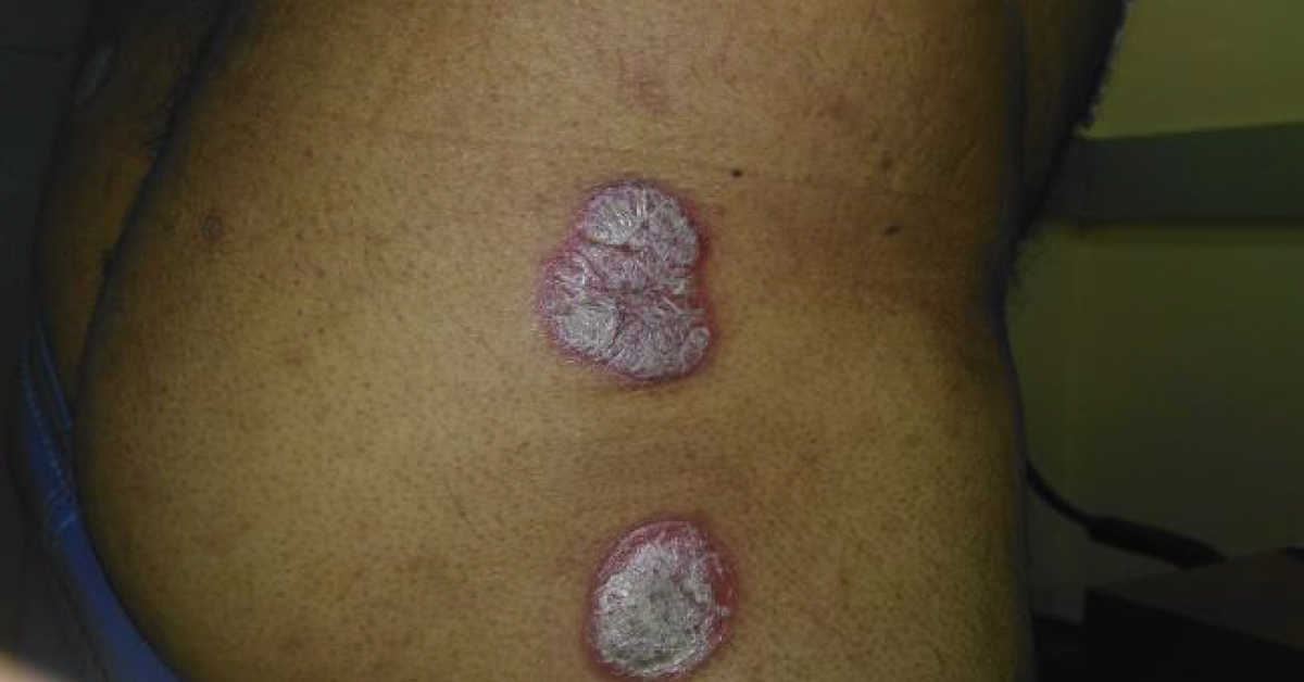 Diagnose The Chronic Skin Lesions