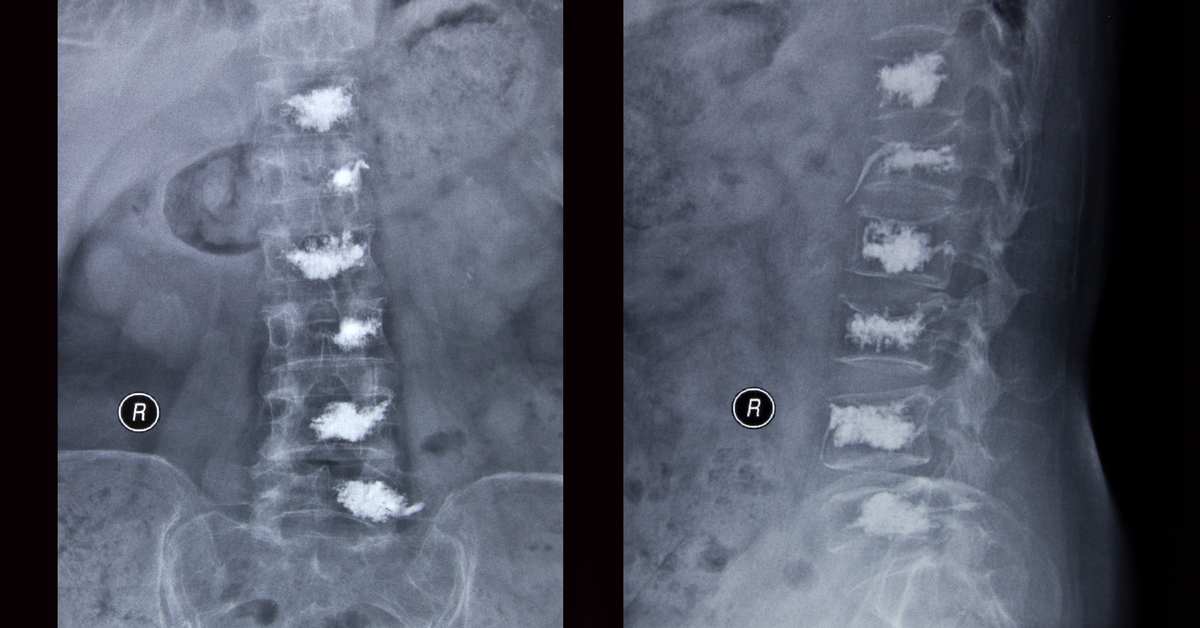 Painful Osteoporotic Spine Fractures Can Be Fixed Without Major Surgery