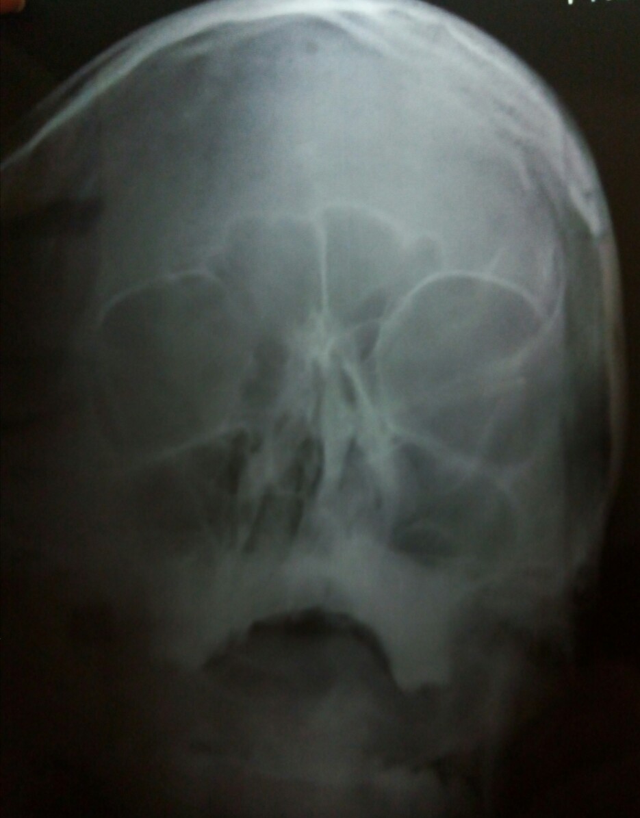 Headache In Teenager