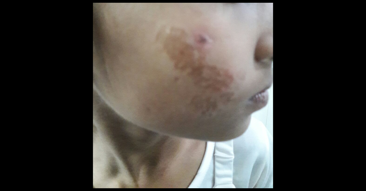 What Is The Reason Of Atrophic Lesion