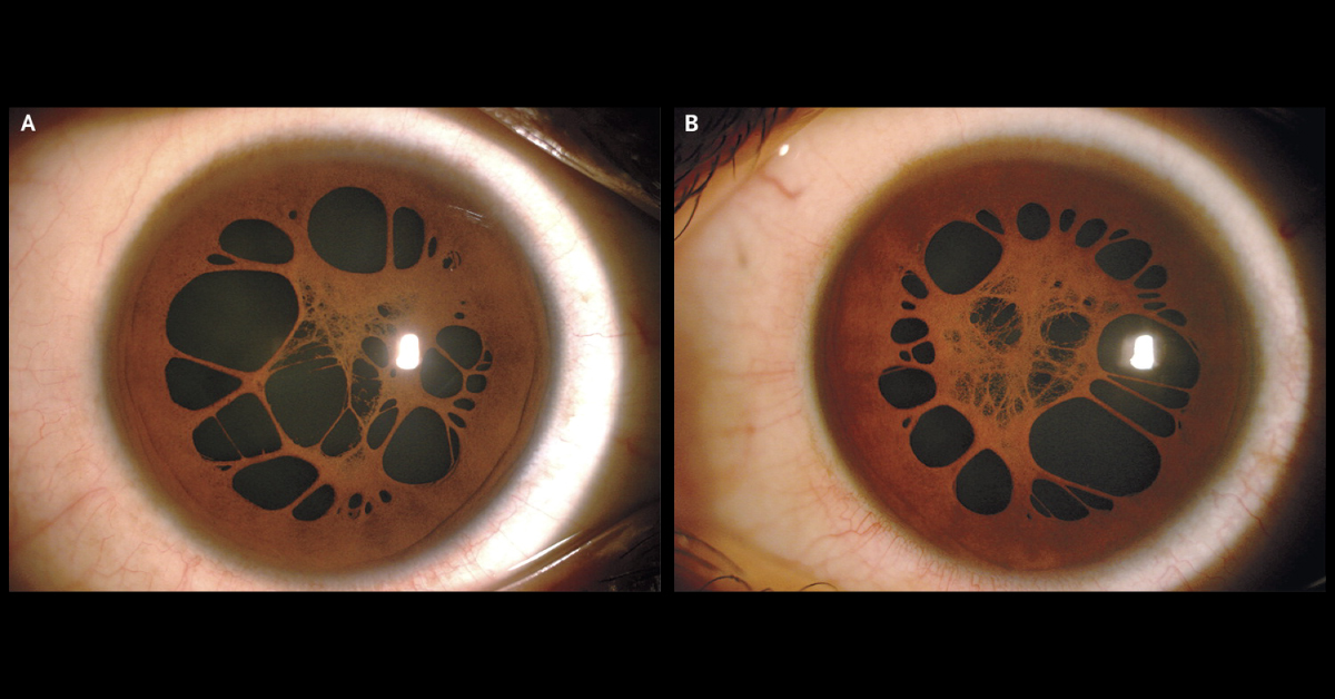 Persistent Pupillary Membrane In A Teenager