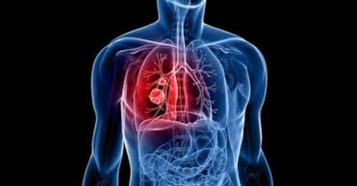 Tissue Sparing Mesothelioma Surgery Generates Better Outcomes