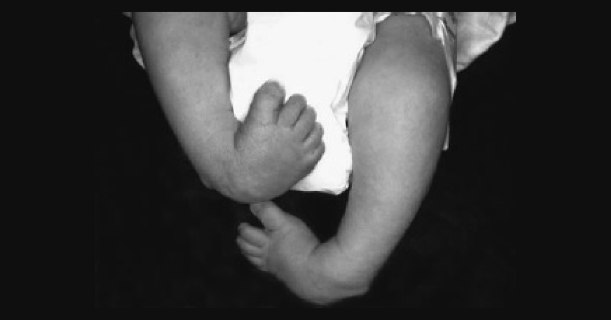Deformed Feet In A New Born Child