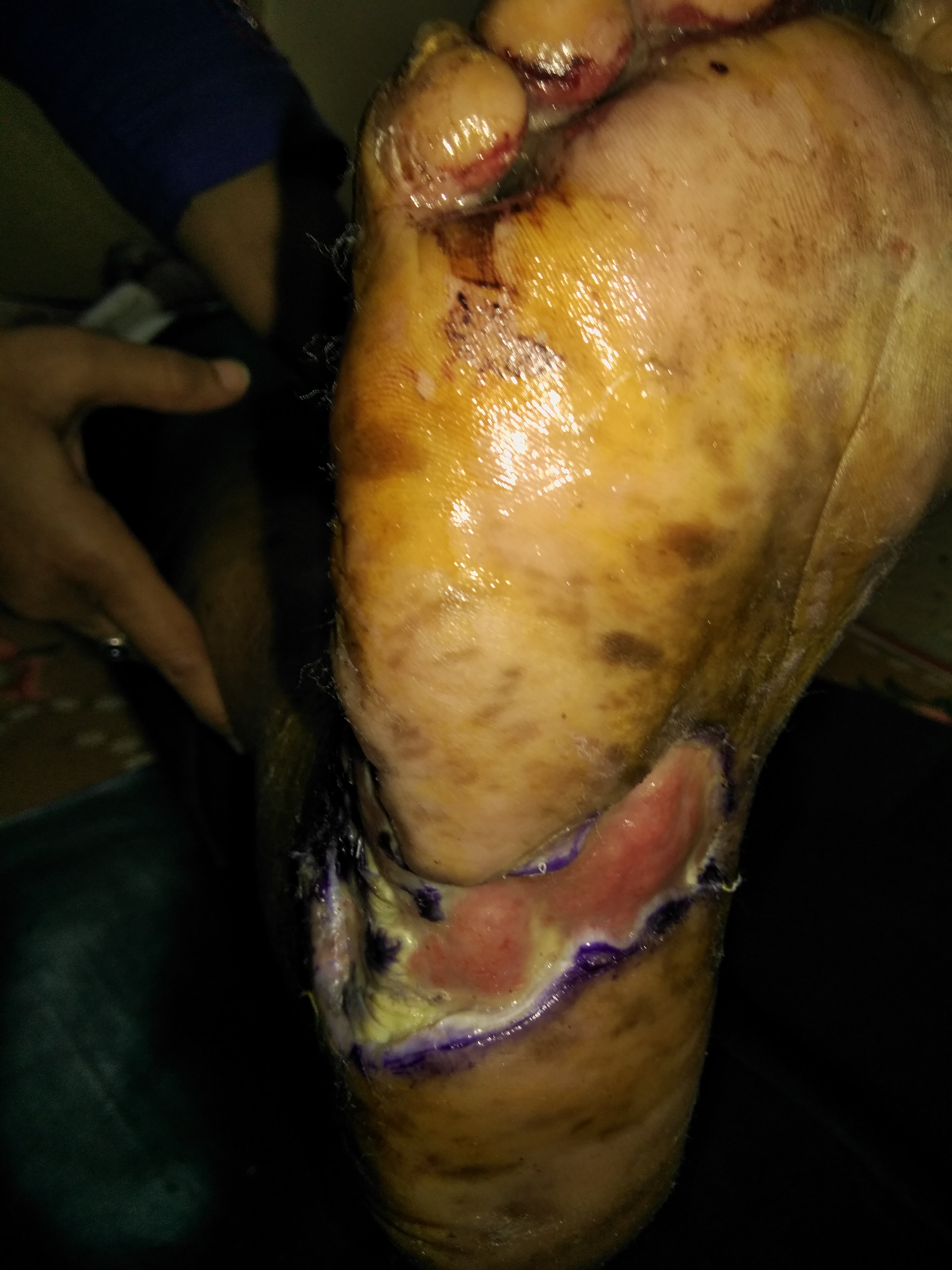 Regression Of Insulin Resistance Diabetic Gangrene Unhealing Wound