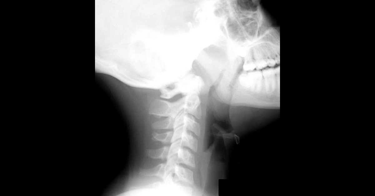 Spot The Condition From Radiograph Of A Recurrent Otitis Media