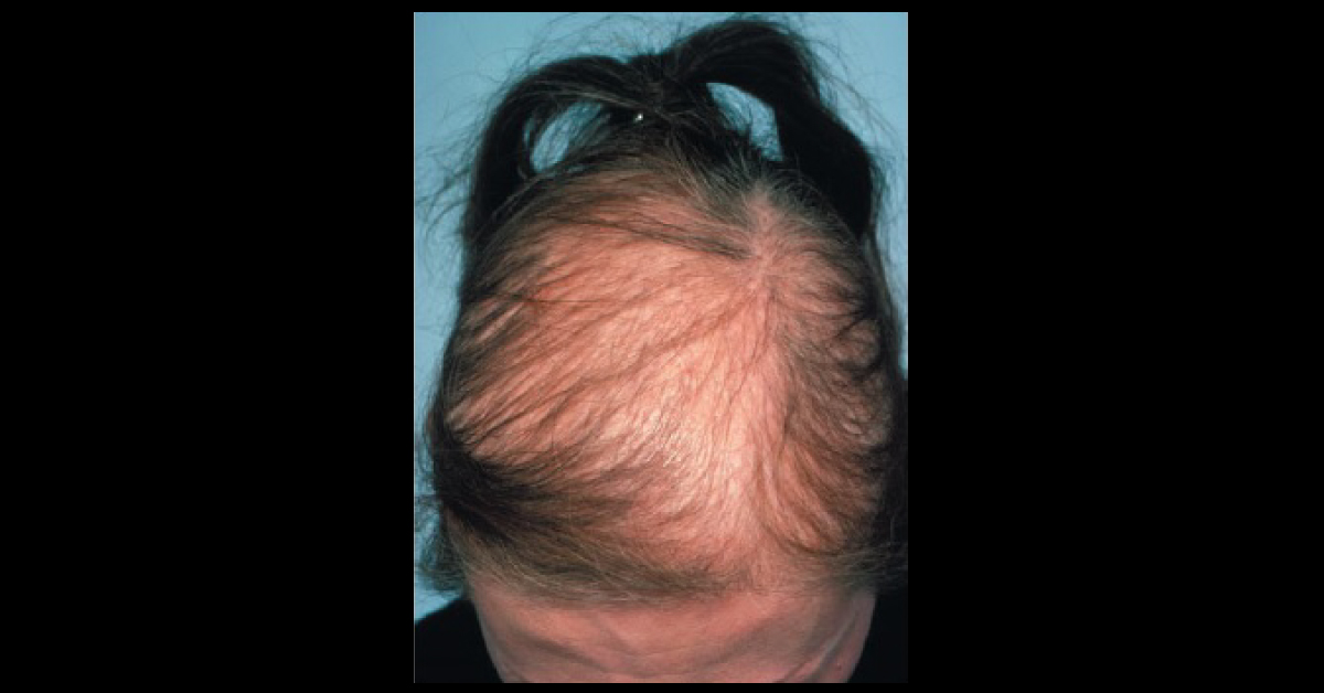 Frontal Hair Loss In A Woman