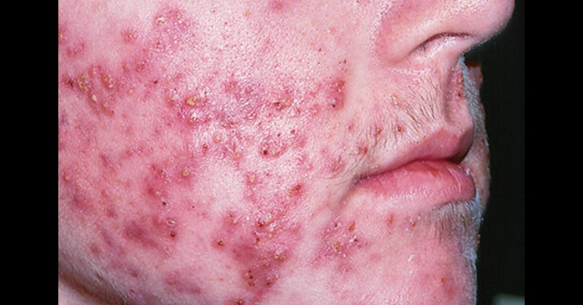 Spot The Derma Condition