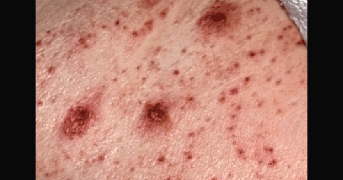 Diagnose The Itchy Rashes