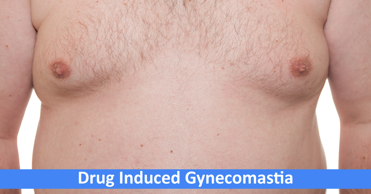 Drug Induced Gynecomastia