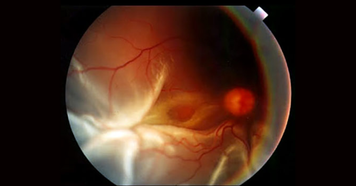 Diagnose The Retinal Disorder