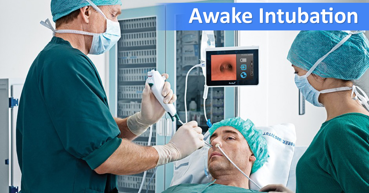 Lollipop Anesthesia For Awake Intubation