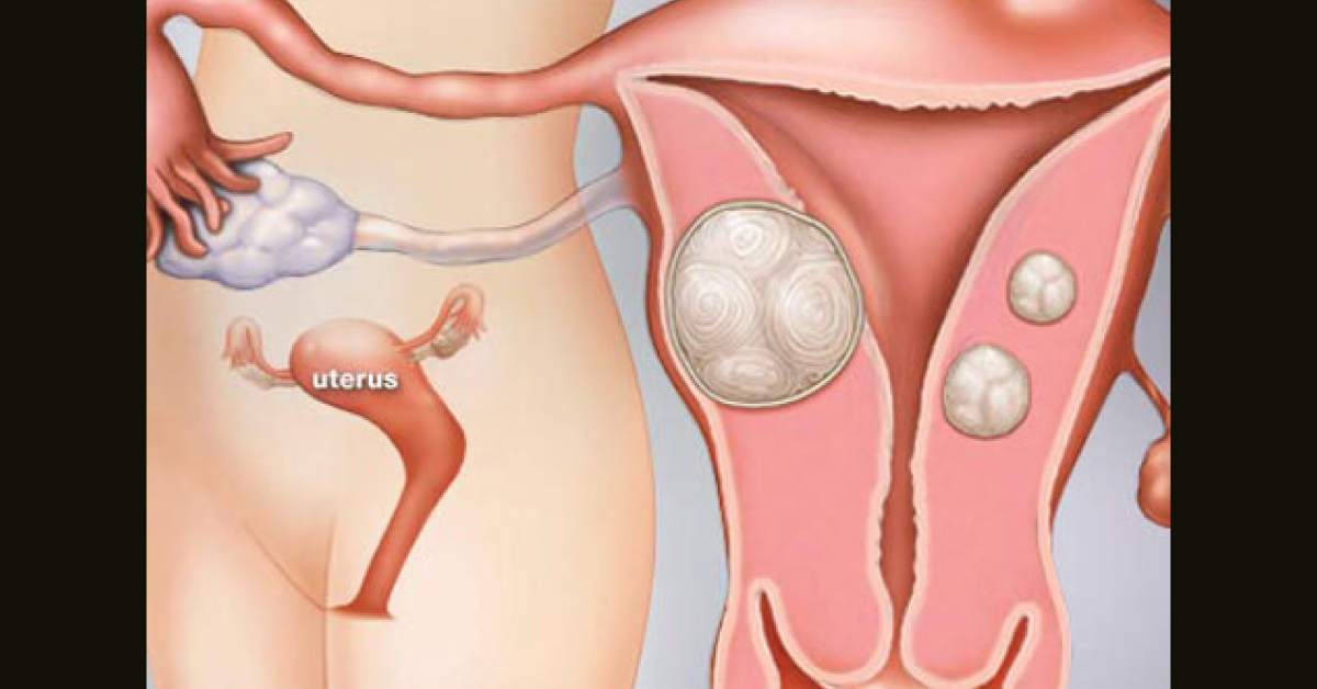 Endometrial Polyps