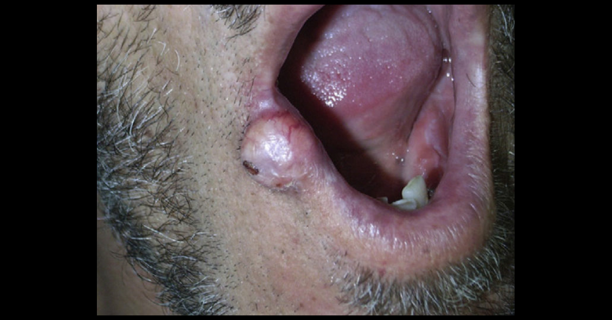 Slow Growing Nodule On The Lower Lip