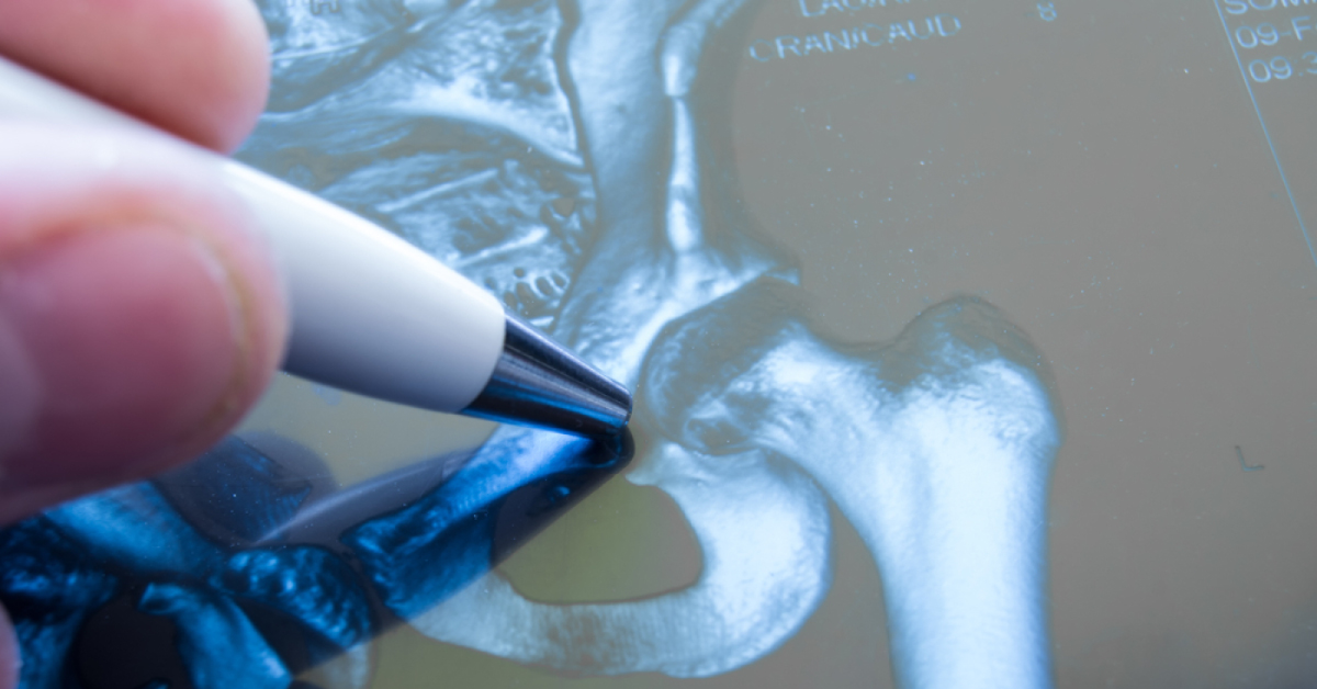 Advanced Imaging For Fracture Risk Evaluation