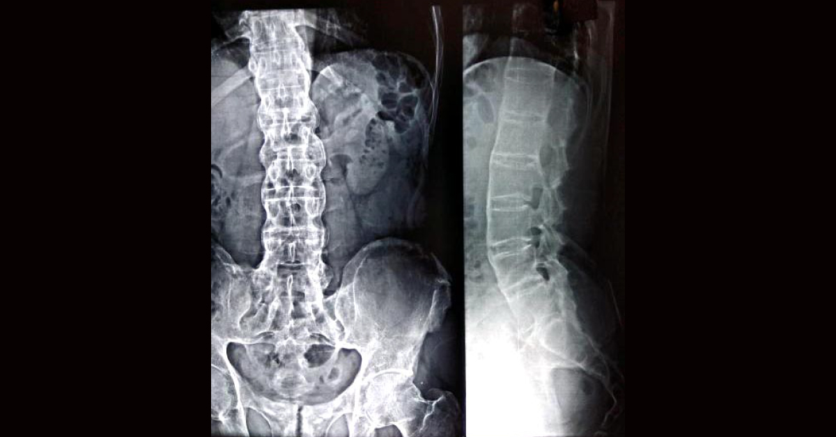 Backache For Many Years, Now Cough And Breathlessness