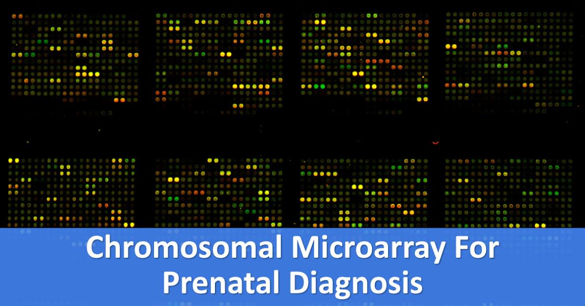 Chromosomal Microarray For Prenatal Diagnosis