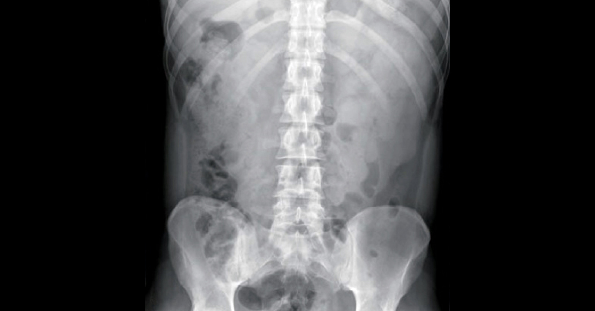 Left Sided Loin Pain In A Young Man