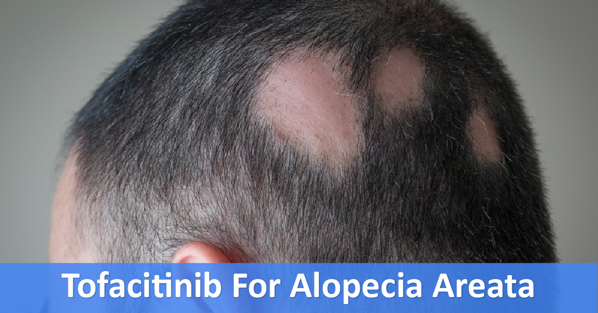 Tofacitinib For Alopecia Areata