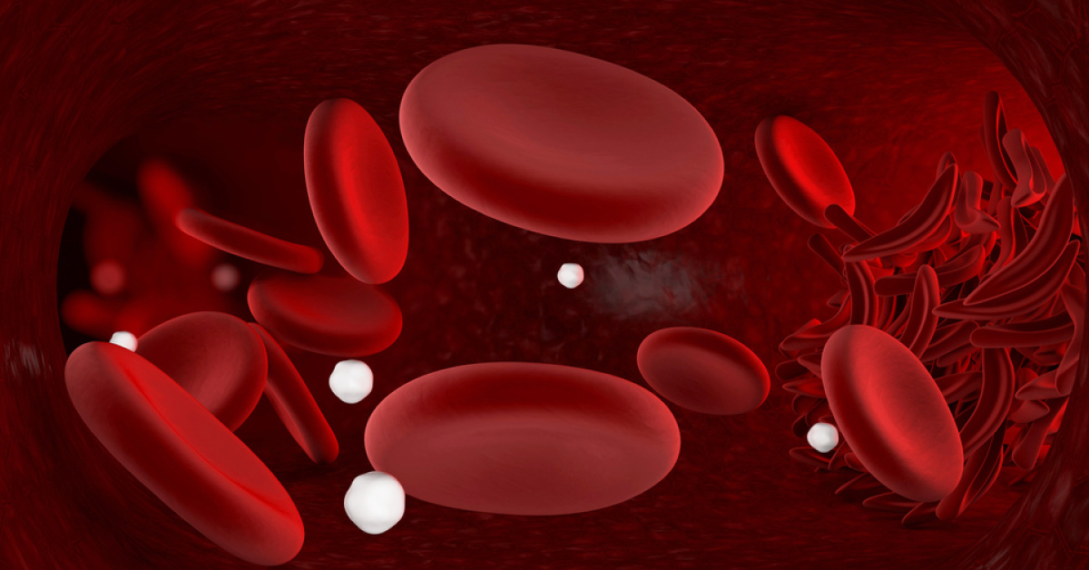 Diagnosis and Management of Hereditary Spherocytosis