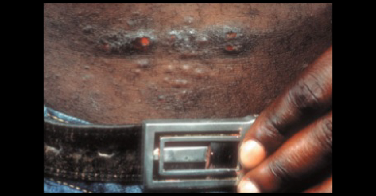 Spot The Reason Behind This Itchy Rash