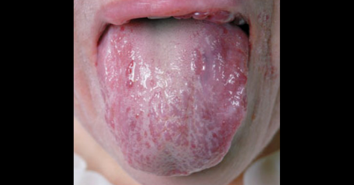Tongue Thickening and Progressive Weakness In An Elderly Woman