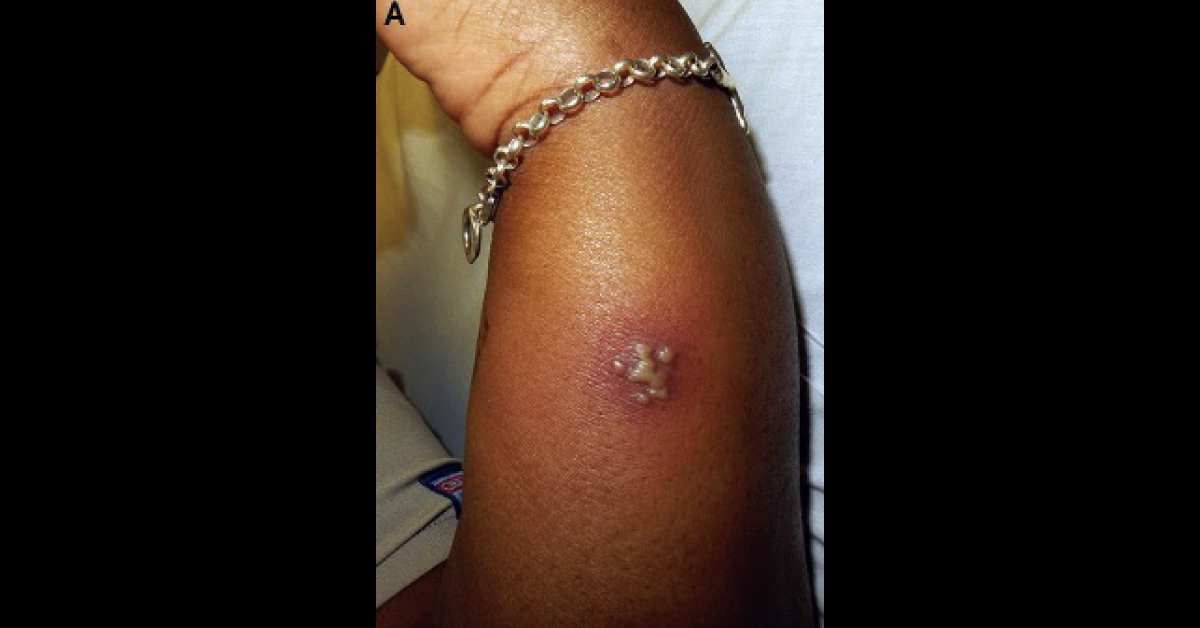 Painful Pustules With Erythematous Base