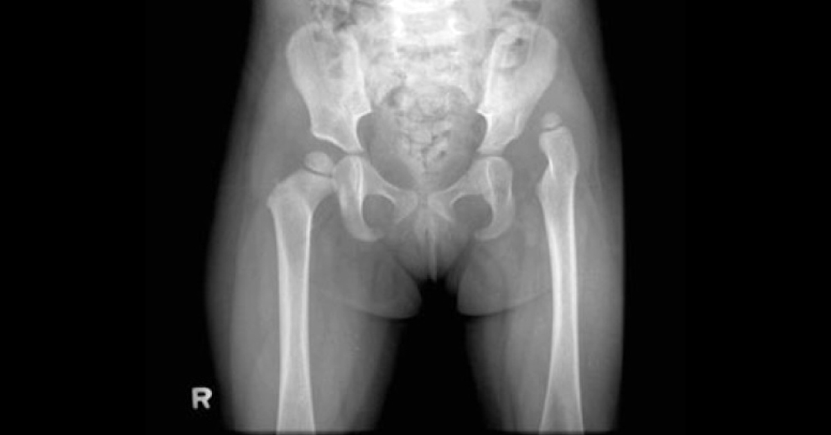 A Clicky Hip In A Toddler