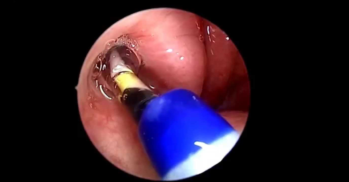Balloon Dilatation Of The Eustachian tube