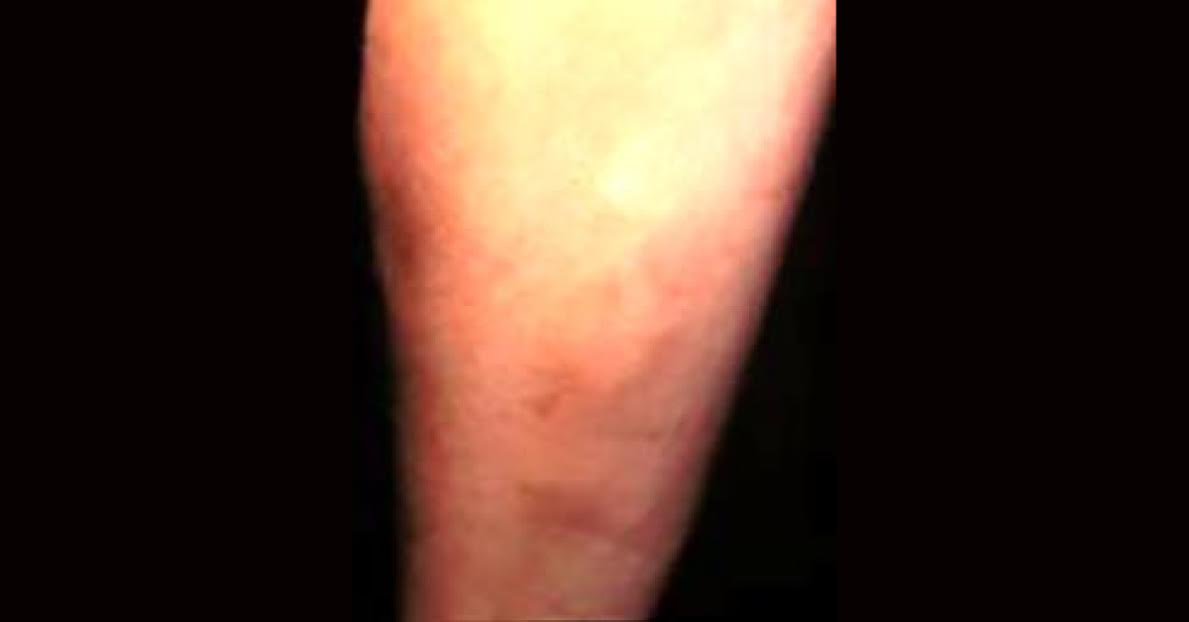 Asymptomatic Bumps On Extremities