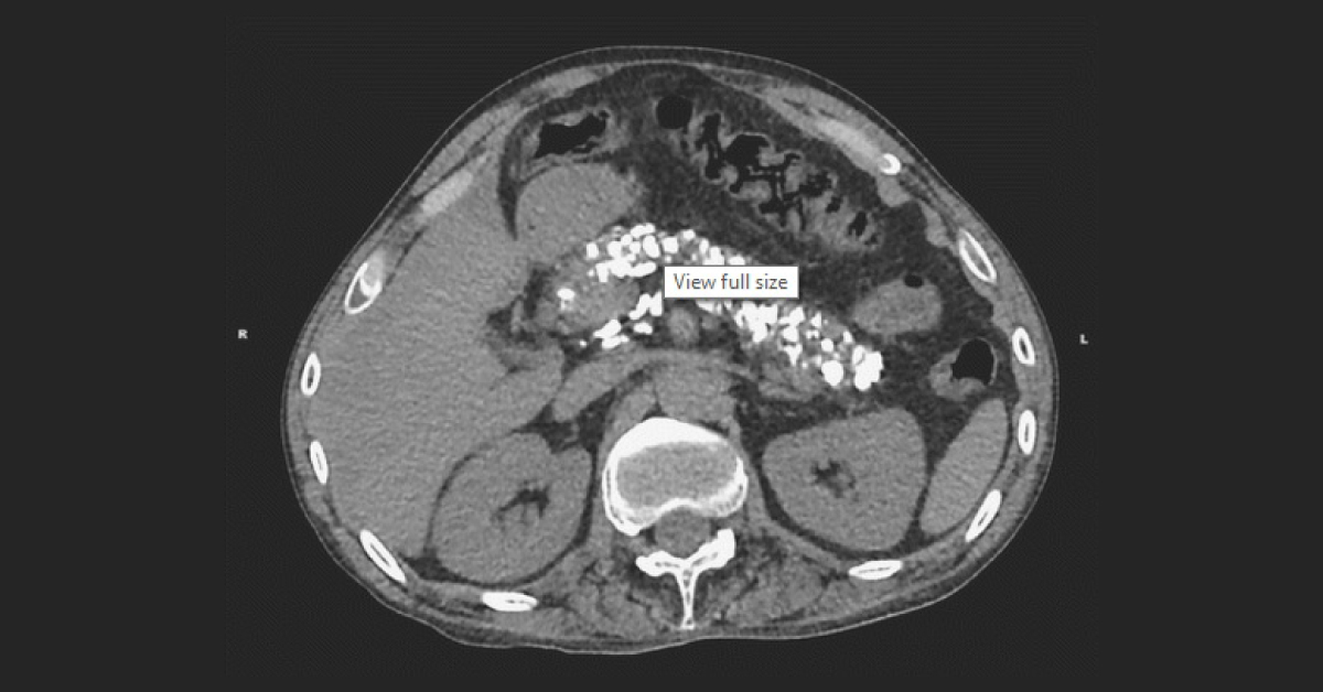 Case Of Hematemesis And Epigastric Pain
