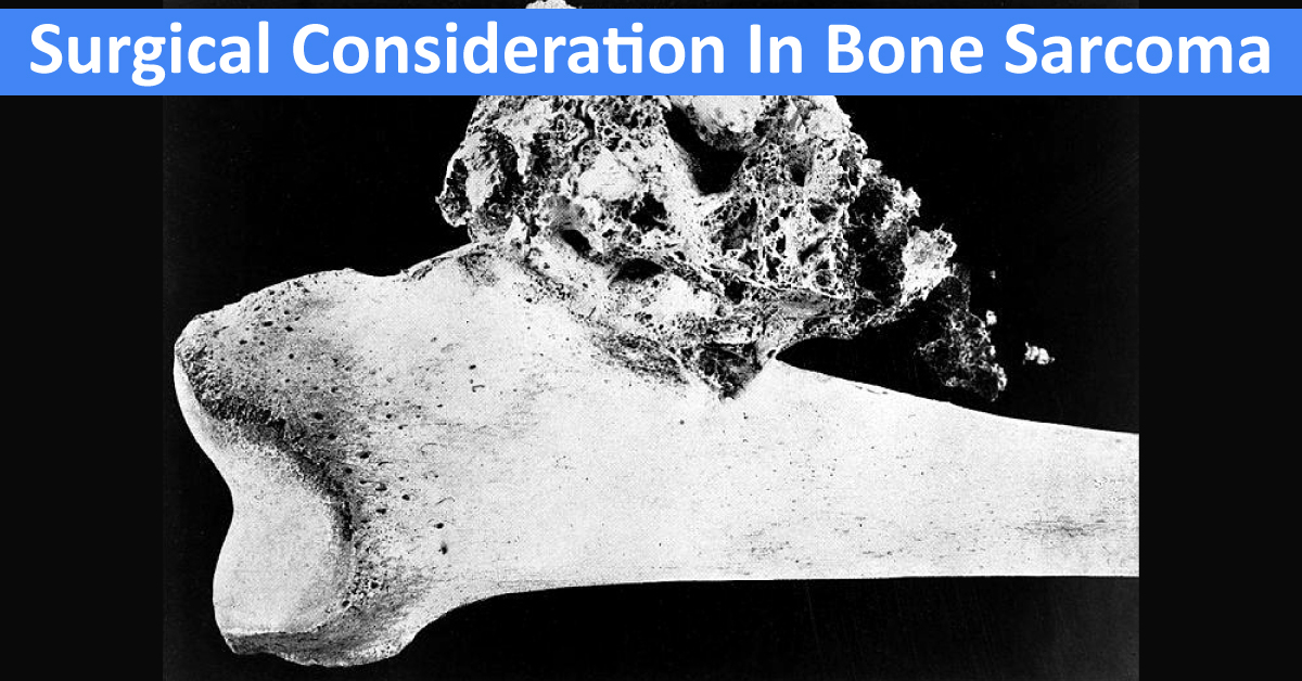 Considerations For Bone Sarcoma Surgeries