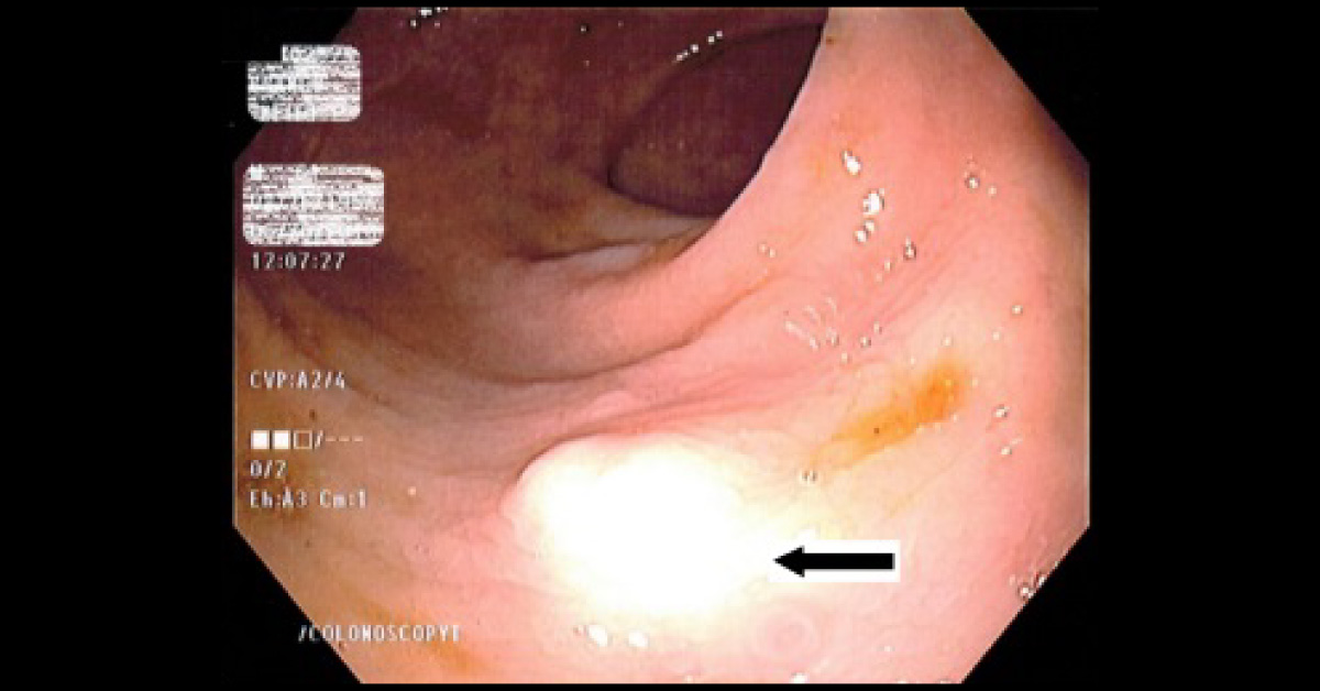 Identify The Rare Type Of Tumor In Rectum