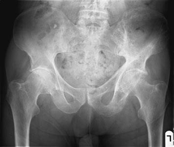 Hip Pain And Abnormal Blood Tests
