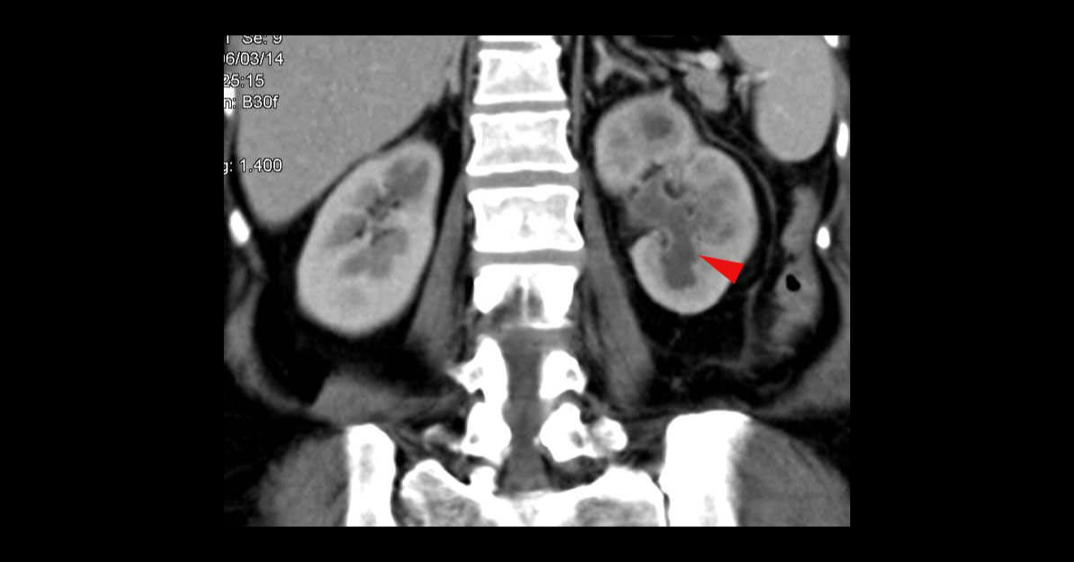 Spot The Renal Complication